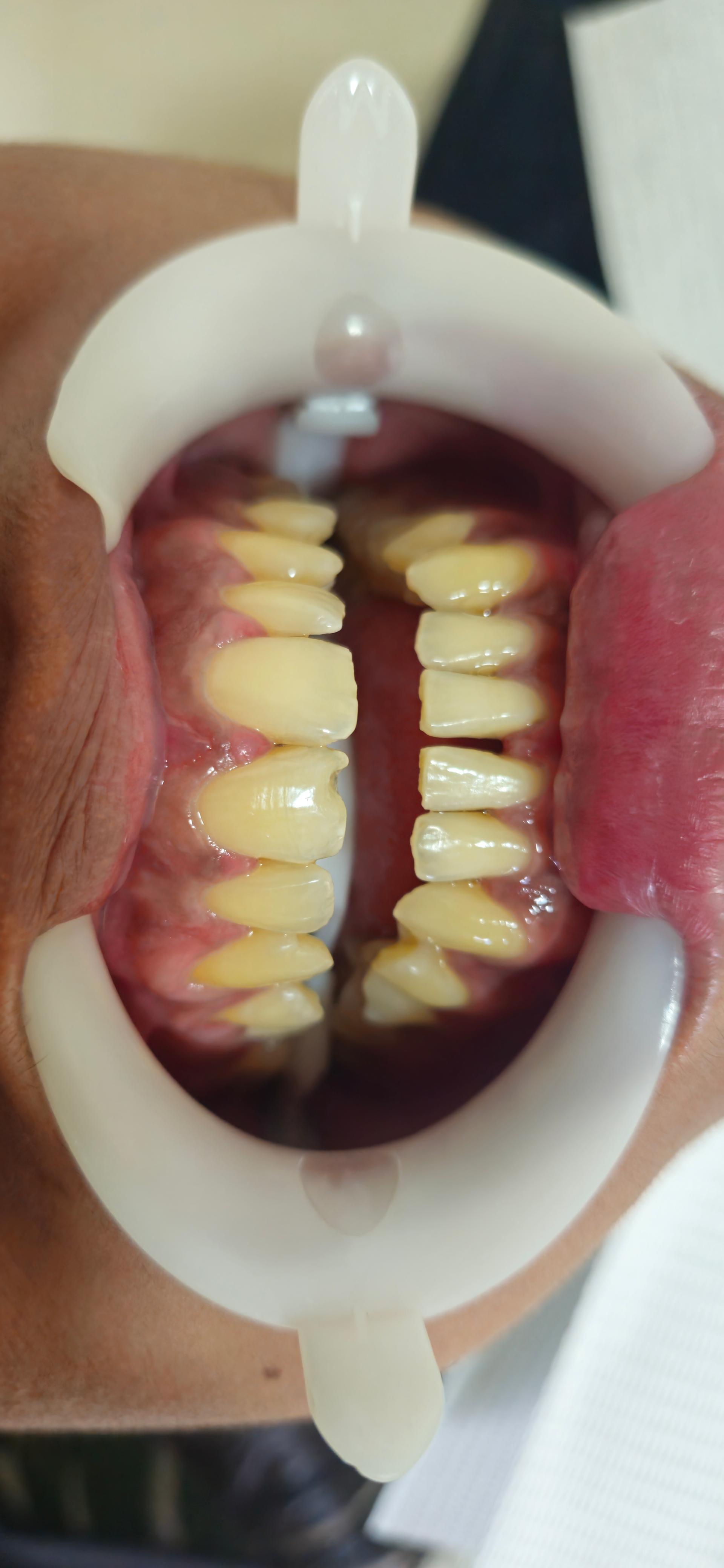 Antes do clareamento