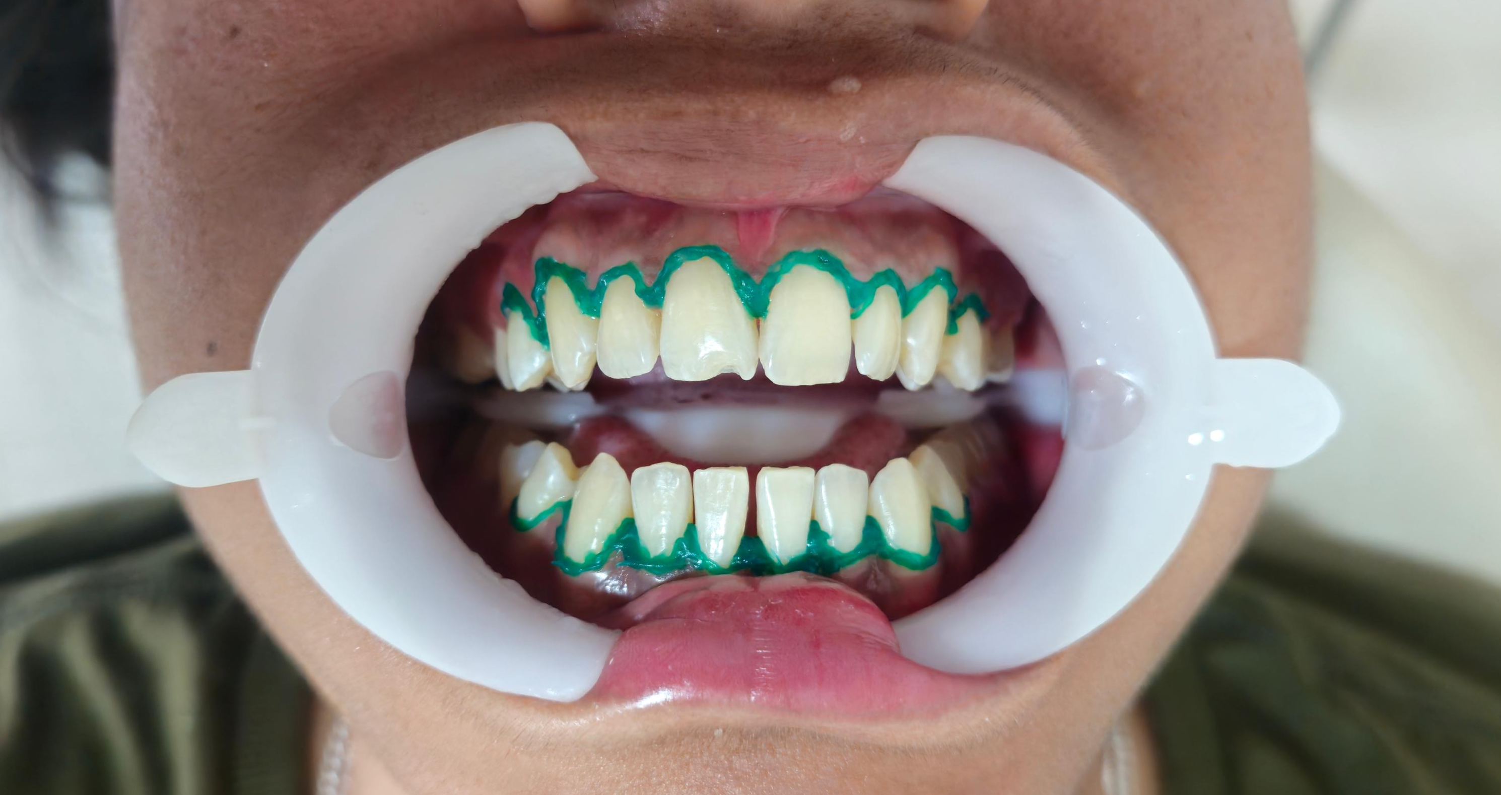 Depois do clareamento